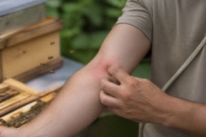 Allergie piqure d'abeille : symptômes, risques et prévention en apiculture