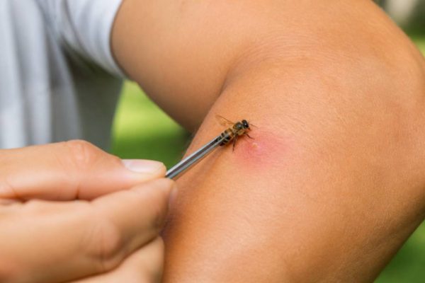 Piqûre d’abeille : que faire pour soulager la douleur et éviter les complications