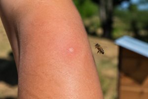 À quoi ressemble une piqûre d’abeille ? Symptômes, réaction et gestes à adopter