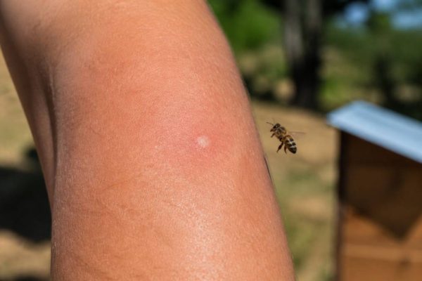 À quoi ressemble une piqûre d’abeille ? Symptômes, réaction et gestes à adopter